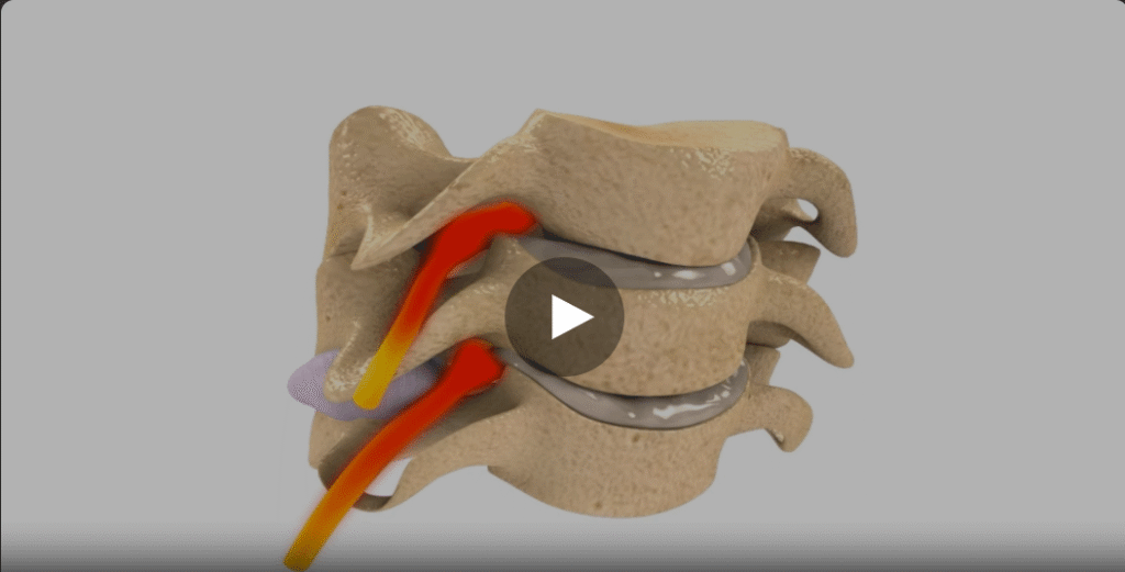 Subluxation video