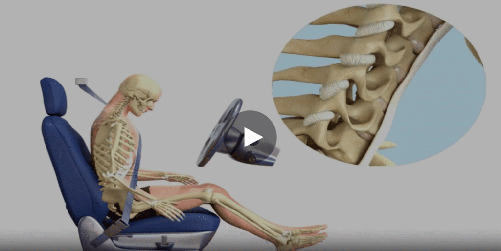 Whiplash Video in Coral Springs, FL